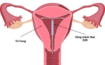 Cổ tử cung ngắn có đặt vòng được không? Khi nào nên trì hoãn tránh thai