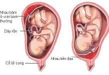 Rau tiền đạo khi mang thai: Nguyên nhân, dấu hiệu và cách điều trị rau-tien-dao-khi-mang-thai-3