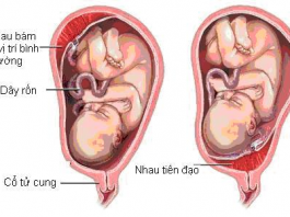 Rau tiền đạo khi mang thai: Nguyên nhân, dấu hiệu và cách điều trị rau-tien-dao-khi-mang-thai-3