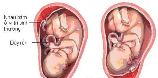 Rau tiền đạo khi mang thai: Nguyên nhân, dấu hiệu và cách điều trị rau-tien-dao-khi-mang-thai-3