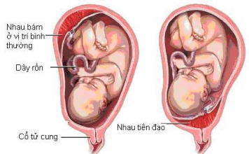 Rau tiền đạo khi mang thai: Nguyên nhân, dấu hiệu và cách điều trị rau-tien-dao-khi-mang-thai-3