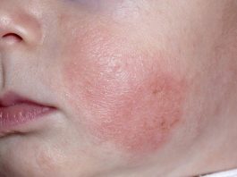 Dưỡng ẩm cho bé có giúp giảm nguy cơ viêm da không?