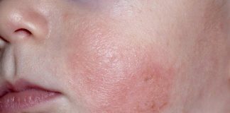 Dưỡng ẩm cho bé có giúp giảm nguy cơ viêm da không?