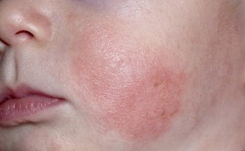 Dưỡng ẩm cho bé có giúp giảm nguy cơ viêm da không?