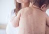 Sốt xuất huyết ở trẻ sơ sinh: Dấu hiệu cha mẹ dễ bỏ sót và cách bảo vệ con sot-xuat-huyet-o-tre-so-sinh-dau-hieu-cha-me-de-bo-qua-1