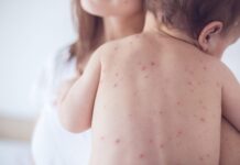 Sốt xuất huyết ở trẻ sơ sinh: Dấu hiệu cha mẹ dễ bỏ sót và cách bảo vệ con sot-xuat-huyet-o-tre-so-sinh-dau-hieu-cha-me-de-bo-qua-1