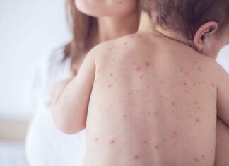 Sốt xuất huyết ở trẻ sơ sinh: Dấu hiệu cha mẹ dễ bỏ sót và cách bảo vệ con sot-xuat-huyet-o-tre-so-sinh-dau-hieu-cha-me-de-bo-qua-1