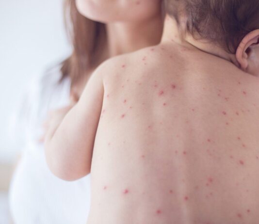 Sốt xuất huyết ở trẻ sơ sinh: Dấu hiệu cha mẹ dễ bỏ sót và cách bảo vệ con sot-xuat-huyet-o-tre-so-sinh-dau-hieu-cha-me-de-bo-qua-1
