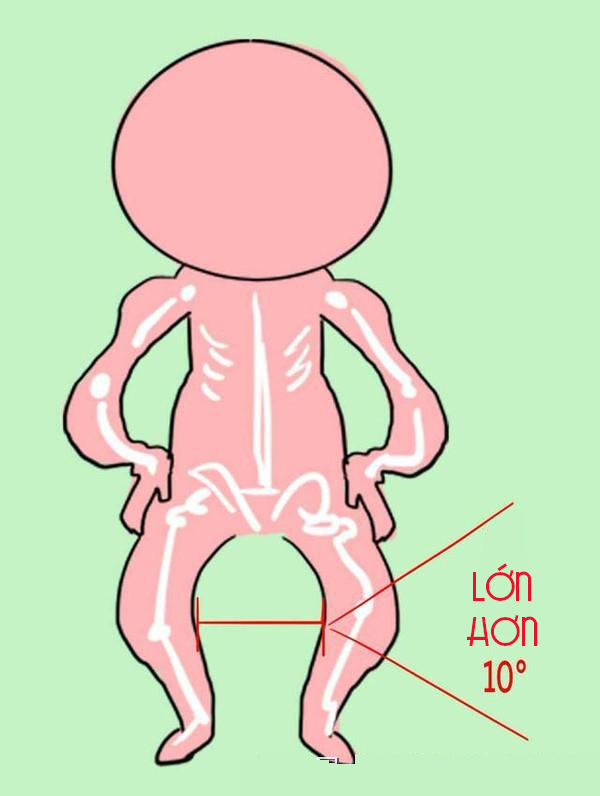 Đưa trẻ di gặp bác sĩ nếu như bé bị chân vòng kiềng quá nặng