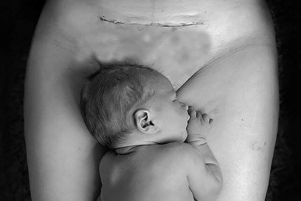 12 điều mà bất kì bà mẹ sinh mổ nào cũng cần phải tránh 12 điều mà bất kì bà mẹ sinh mổ nào cũng cần phải tránh